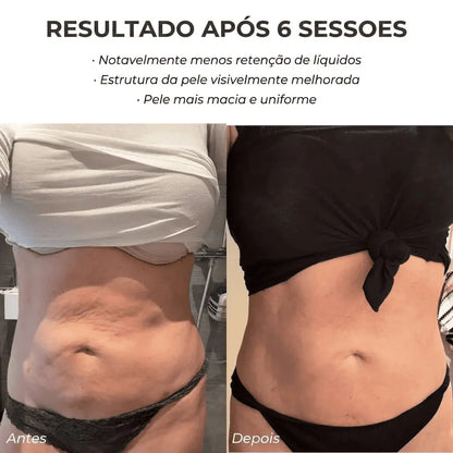 DermaShape™ Anti-Celulite